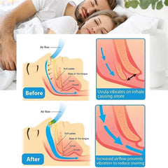 Anti-Snoring Device